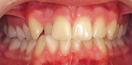 before quick straight teeth treatment