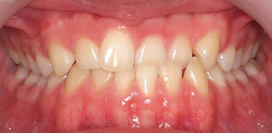 before quick straight teeth treatment