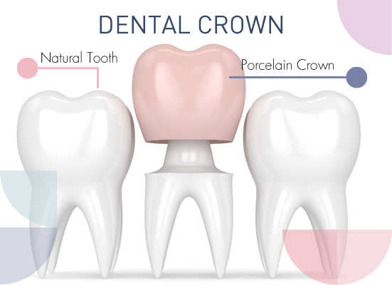 dental crowns