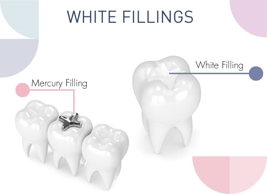 white fillings in northern ireland